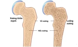 Loãng xương tiến triển âm thầm Loãng xương tiến triển âm thầm